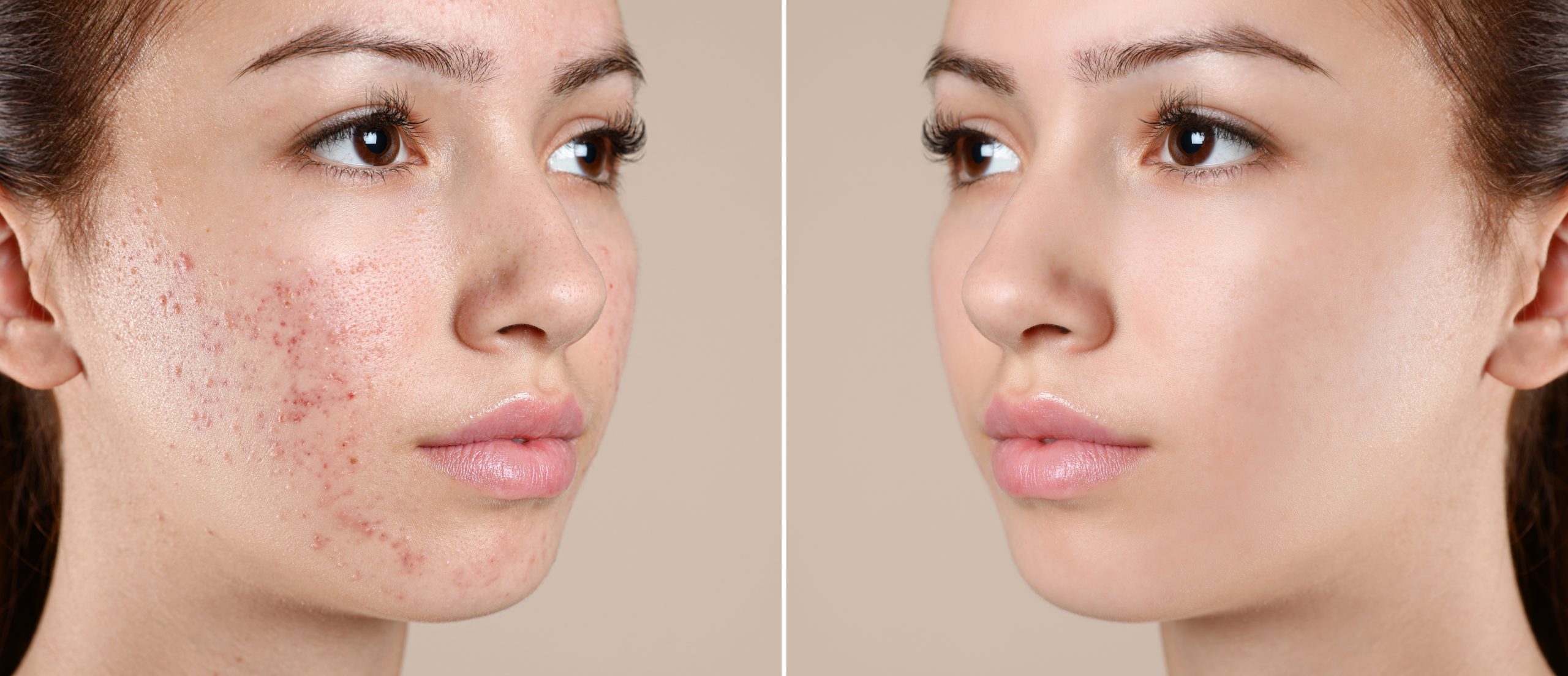 Facials Syracuse NY