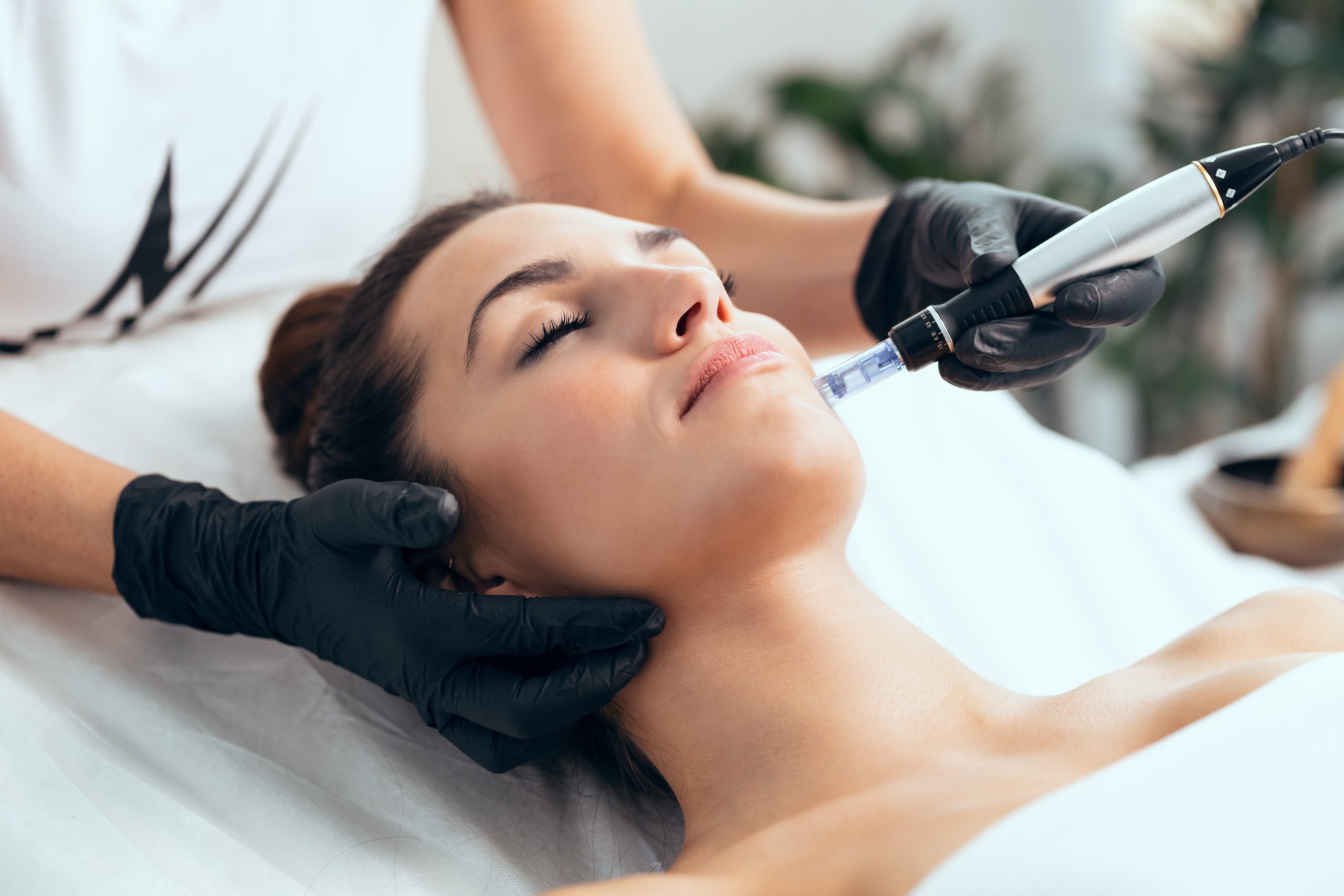 Woman receiving microneedling treatment to improve skin texture and tone at Sedora Spa Syracuse